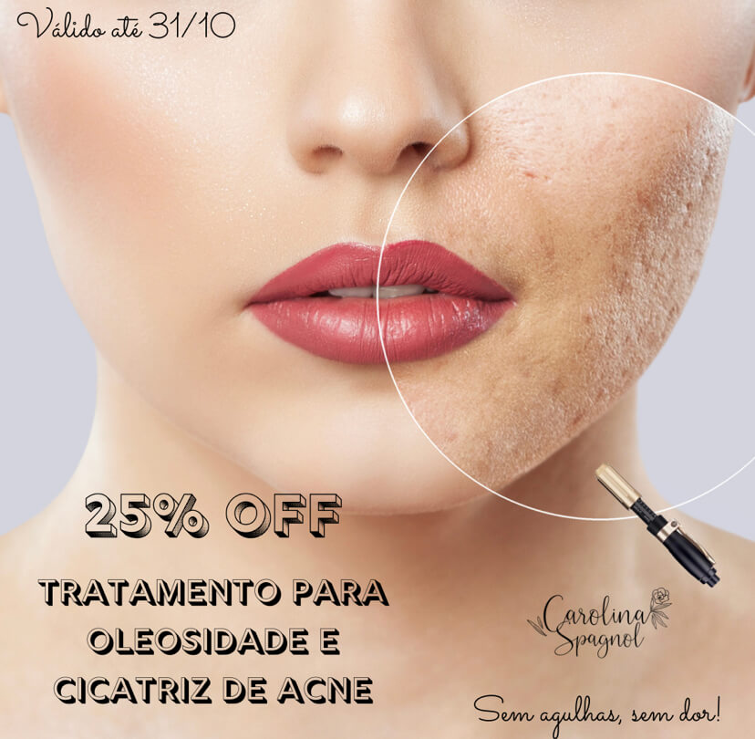 Cicatriz De Acne E Oleosidade Nunca Mais - Hyaluron Pen - Sem Dor E Sem Agulhas