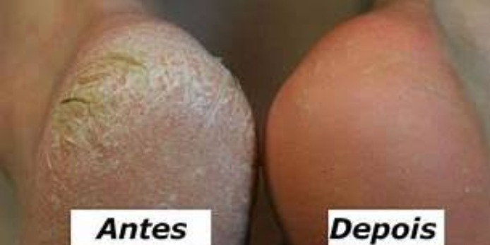 Spa Dos Pés Com Esmaltação