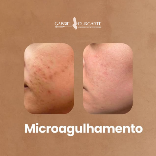 Microagulhamento Facial Ou Corporal