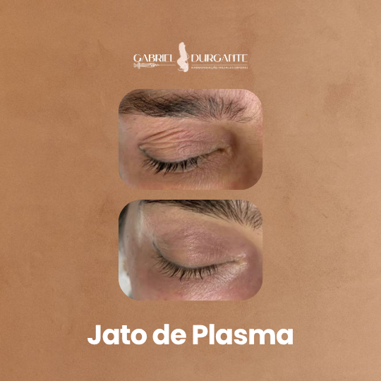Jato De Plasma